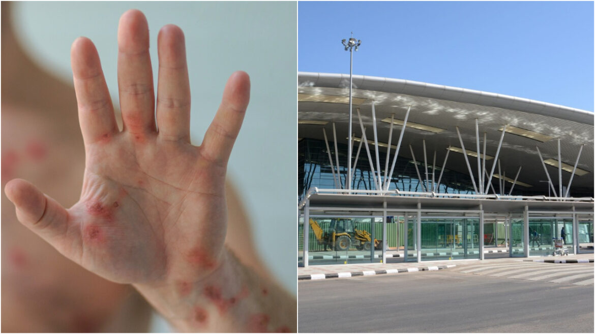 Mpox Bengaluru